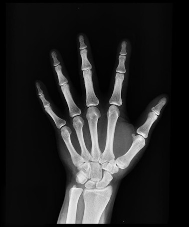 On-Demand: Treatment of the Stiff Hand (Recorded March 12, 2024)